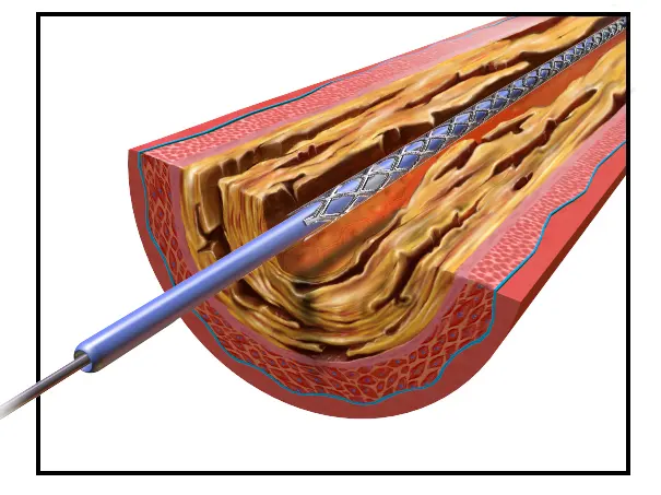 Stent coronario cerrado (antes de la dilatación)