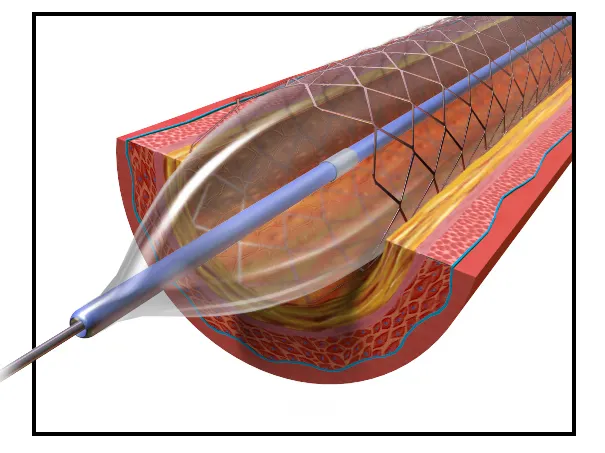 Stent coronario abierto (arteria desobstruida)