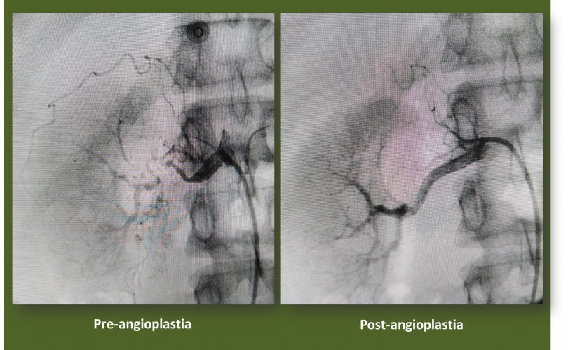 Angioplastia de arterias renales SCITE