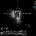 IVUS1