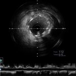 ivus4