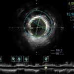 ivus5