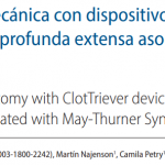 ClotTriever en May Thurner