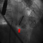 Amplatzer-Plug-II-liberado-a-nivel-del-leak